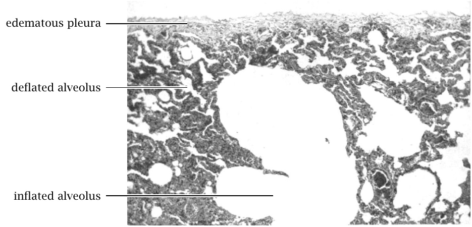 Emphysema and atelectasis in early fatalities