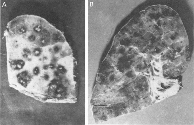 Focal and confluent hemorrhage, inflammation, and necrosis of the
                      lungs in later fatalities