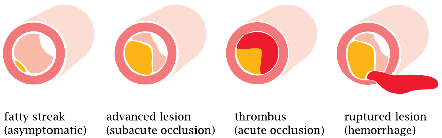 Sketch of atherosclerotic lesions, from fatty streak to parietal
                    thrombus and vessel rupture