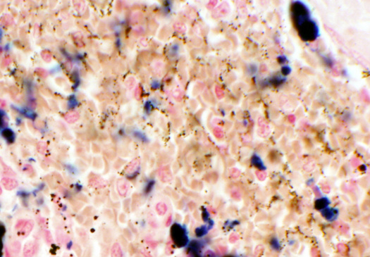 Hemosiderin in liver tissue