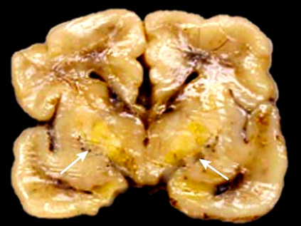 Bilirubin encephalopathy (“kernicterus”)