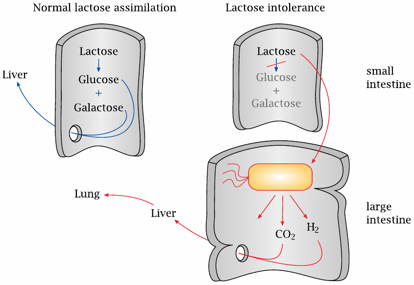 Schematic of the pathophysiology of lactose intolerance: Lactose
                    remains undigested in the small intestine and is instead fermented by bacteria
                    in the large intestine