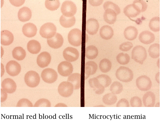 Disruption of heme synthesis causes microcytic, hypochromic anemia