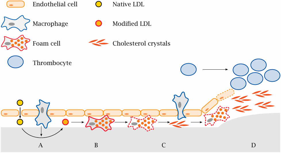 Schematic illustrating the roles of LDL, macrophages, and thrombocytes
                    in the development of atherosclerotic lesions.