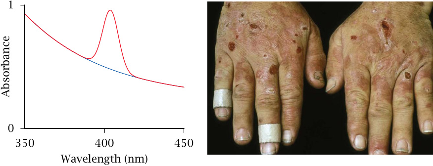 Laboratory and clinical findings in PCT