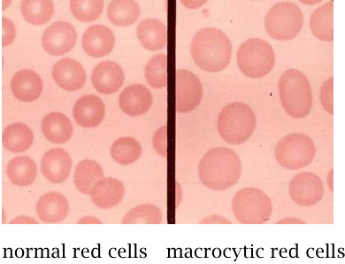 Microscopic images of normal and macrocytic erythrocytes