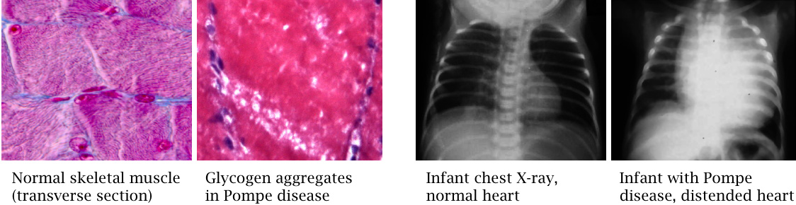 Glycogen inclusions in muscle tissue, and X-ray picture of an enlarged
                    heart in a child with Pompe disease