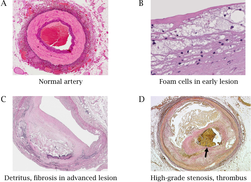 Appearance of atherosclerotic lesions