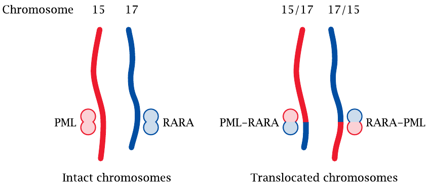 A chromosomal translocation causes promyelocytic leukemia